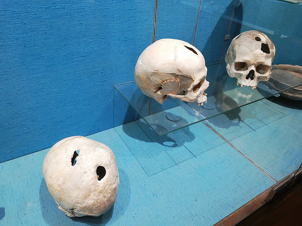 La trapanazione del cranio